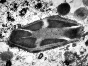 M,15y. | crystalline inclusion in plasmocyte - histiocyto-eosinophilic granuloma